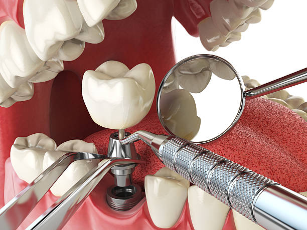 Best Emergency Dentist for Knocked-Out Tooth in Pocola, OK